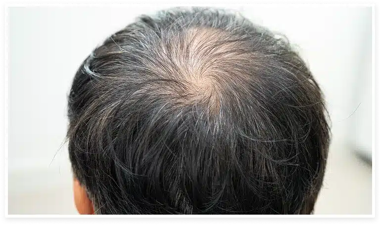 mujer u hombre con signos de alopecia