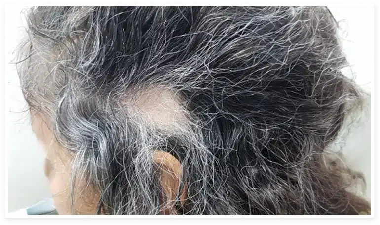 Cabeza de una persona con alopecia areata
