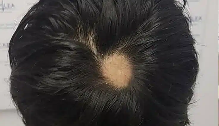 Cabeza de una persona con alopecia areata