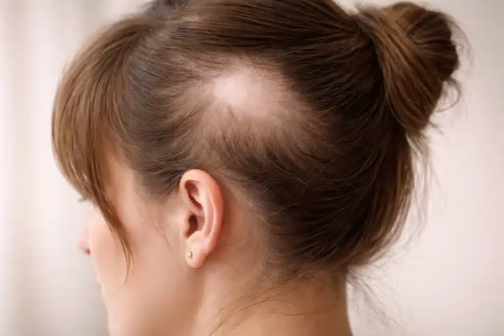 Mujer con alopecia cicatricial