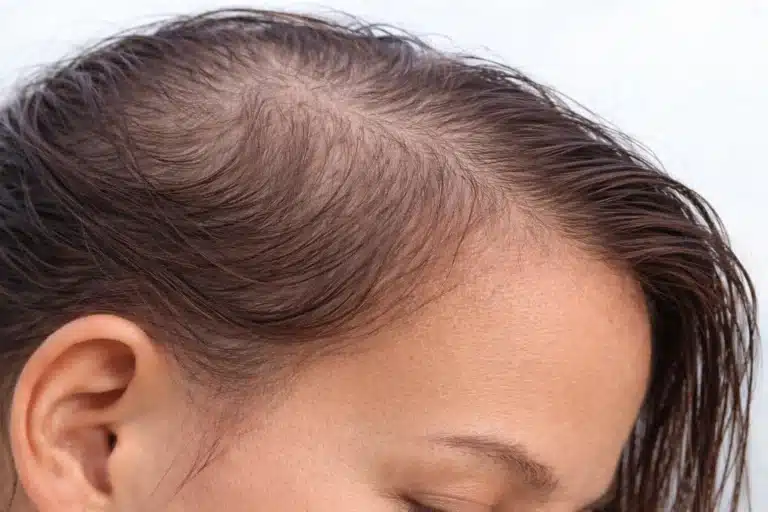 Mujer con alopecia difusa